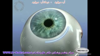 درمان آب مروارید - مرکز چشم پزشکی دکتر علیرضا نادری