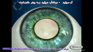 عمل آب مروارید به روش فیکو - مرکز چشم پزشکی دکتر علیرضا نادری