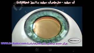 جراحی آب مروارید با لیزر- مرکز چشم پزشکی دکتر علیرضا نادری