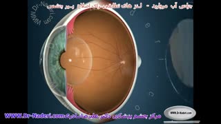 لنزهای داخل چشمی تطابقی - مرکز چشم پزشکی دکتر علیرضا نادری