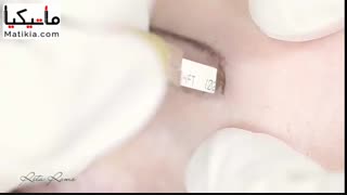 میکروبلیدینگ به روش فیبروز - 09120660447