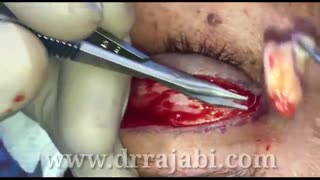 بلفاروپلاستی یا اصلاح پف پلک بالا