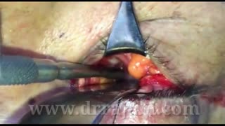 جراحی خارج کردن تومور راس کاسه چشم