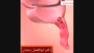 دلایل التهاب آپاندیس