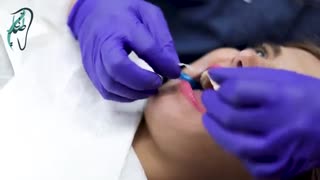 مراقبت های بعد از کامپوزیت ونیر