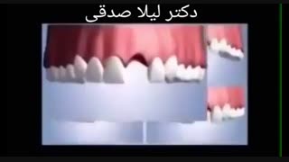 ایمپلنت دندان