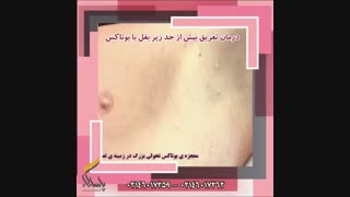 درمان تعریق زیاد با تزریق بوتاکس