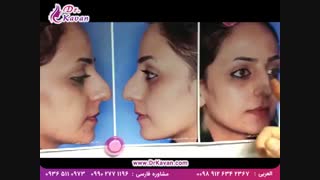 عمل زیبایی و برداشتن قوز بینی