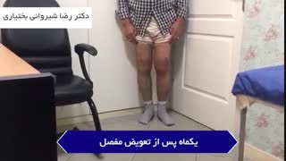 درمان آرتروز شدید و والگوس شدید زانوی  چپ