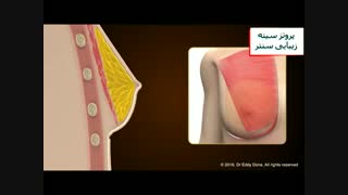 جراحی پروتز سینه - عمل پروتز سینه یا برجسته کردن سینه - زیبایی سنتر