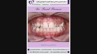 درمان ناهنجاری دندانی شدید | دکتر فیروزی