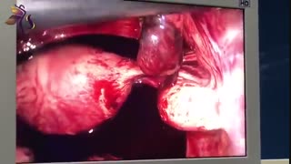 بارداری خارج از رحم