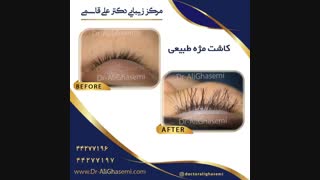 نمونه کار کاشت ابرو، مو ، مژه