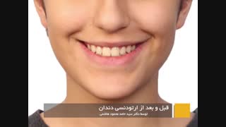 قبل و بعد از ارتودنسی دندان | دکتر محمودهاشمی