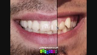 قبل و بعد از درمان ارتودنسی دندان | دکتر محمودهاشمی متخصص ارتودنسی