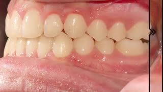 نمونه ارتودنسی دندان | دکتر محمودهاشمی متخصص ارتودنسی