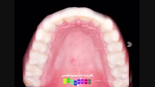 قبل و بعد از درمان ارتودنسی دندان | دکتر محمودهاشمی متخصص ارتودنسی