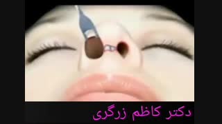 انیمیشن جراحی بینی