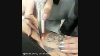 پاک کردن تاتو