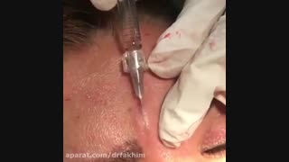 تزریق ژل برای خط اخم