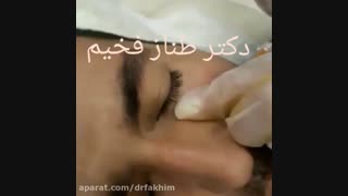 تزریق ژل زیر چشم