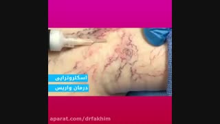 درمان واریس با اسکلروتراپی