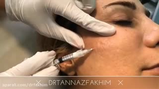 رفع اسکار با تزریق ژل