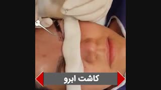 تجربیات کاشت ابرو