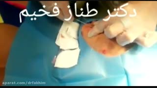 لیفت صورت با نخ