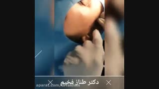 لیفت صورت با نخ و ژل