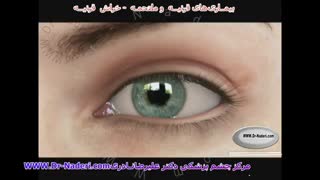 خراش قرنیه - مرکز چشم پزشکی دکتر علیرضا نادری