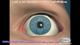 عروق غیرطبیعی قرنیه-مرکز چشم پزشکی دکتر علیرضا نادری