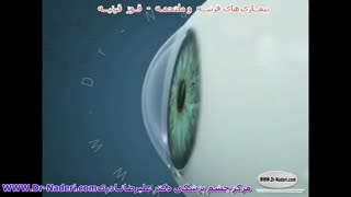 قوز قرنیه یا کراتوکونوس - مرکز چشم پزشکی دکتر علیرضا نادری