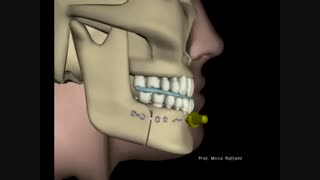 جراحی زیبایی فک و چانه - عمل زاویه سازی صورت  فک بالا و فک پایین - زیبایی سنتر