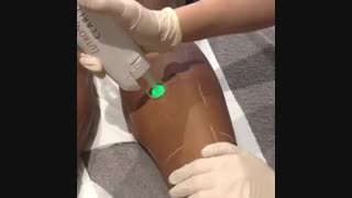 اجاره لیزر الکساندرایت