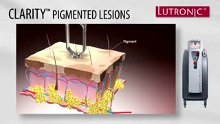 اجاره لیزر الکساندرایت