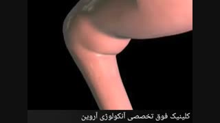 سرطان دهانه رحم