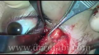 جراحی تومور کاسه چشم وسیع با چسبندگی های متعدد