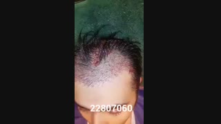 کاشت مو - دکتر ابدالی - 22807060