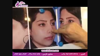 عمل زیبایی بینی توسط دکتر کاوان