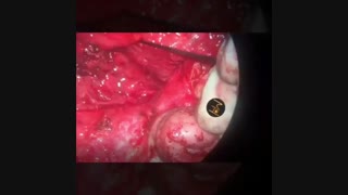 بررسی سلامت عصب صورت بعد از جراحی تومور پاروتید