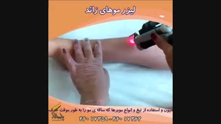 لیزر موهای زائد درد دارد ؟