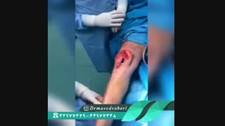 تعویض مفصل زانو خشک | دکتر مسعود صابری متخصص ارتوپد پوسیدگی دندان