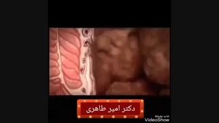 علل شایع بواسیر | دکتر امیر طاهری