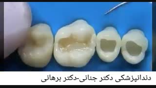 ترمیم دندان با مواد همرنگ