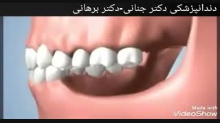 عوارض تحلیل لثه و از دست رفتن دندان ها