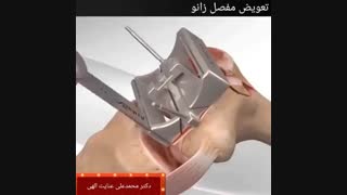 تعویض مفصل زانو