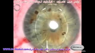 جراحی کارگذاری لنز آرتیزان و آرتیفلکس-مرکز چشم پزشکی دکتر علیرضا نادری