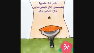 انیمیشن زایمان سزارین | دکتر ندا حاجیها هایفوتراپی