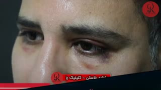 بلفاروپلاستی | فیلم بلفاروپلاستی | کلینیک پوست و مو رز | شماره2